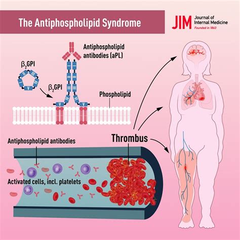 Antiphospholipid Syndrome .